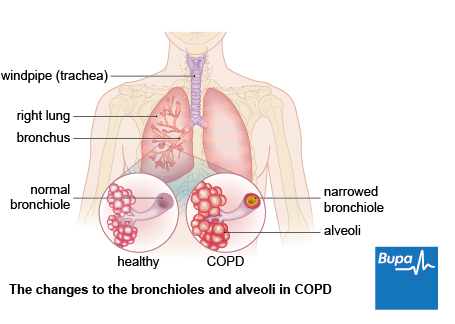 Image result for COPD