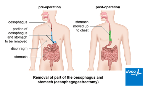 surgery stomach removal happens oesophagus part gastrectomy