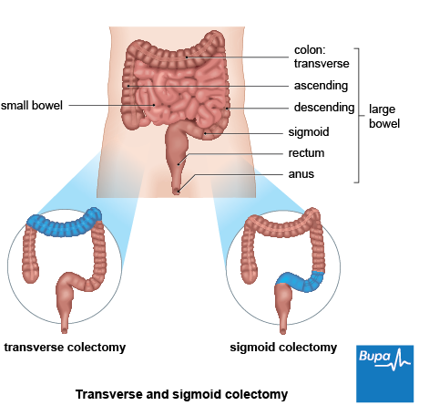 An image showing a transverse and sigmoid colectomy