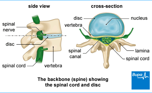 Interlaminar caudal epidural steroid injection