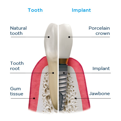 Illustration comparing the parts of a tooth with the parts of dental implant treatment, including the crown and implant