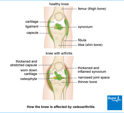 osteoarthritis medscape treatment