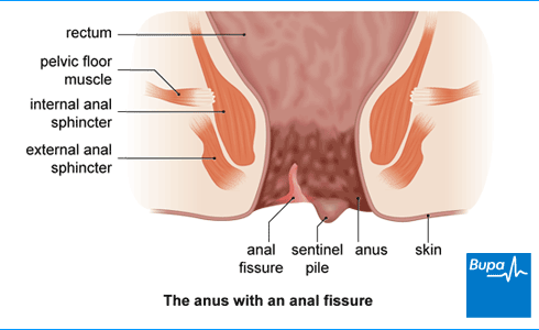 anal fissure image