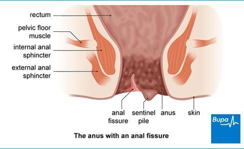 Anal treatment procedure