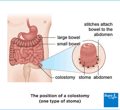 Ostomy Output Chart