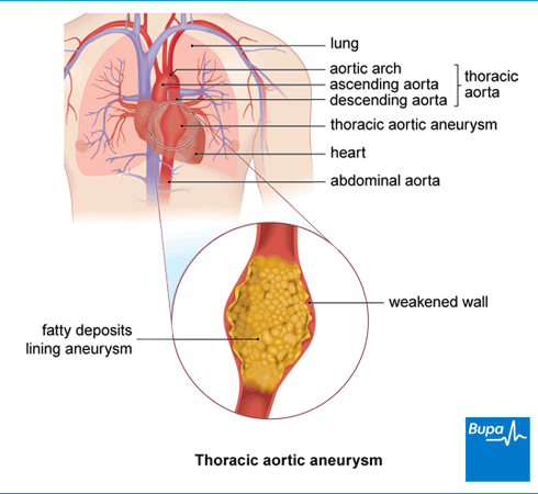 Thoracic aortic aneurysm | Health Information | Bupa UK