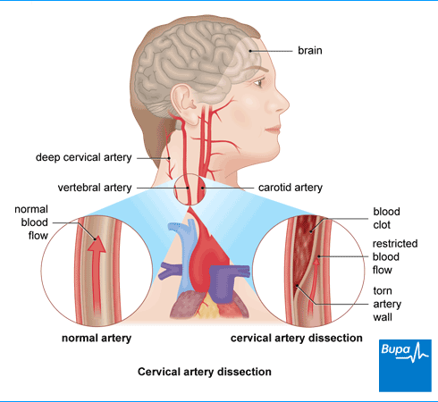 Image result for vertebral artery dissection