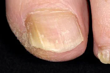 Fungal nail infection