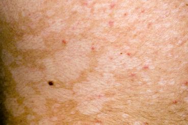 Fungal Skin Infections: Symptoms and Treatments | Bupa UK