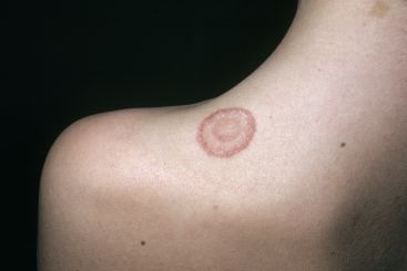 A photo of someone with ringworm