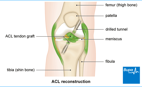 Зображення, на якому показано реконструкцію ACL