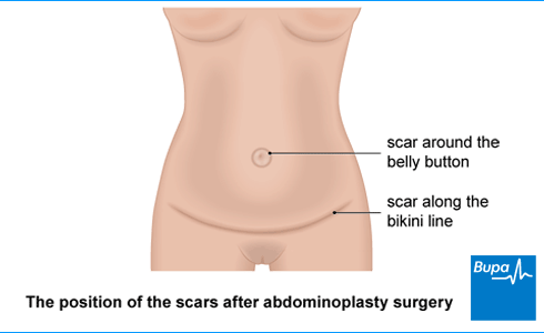 An image showing the position of the scars after abdominoplasty surgery An image showing the position of the scars after abdominoplasty surgery