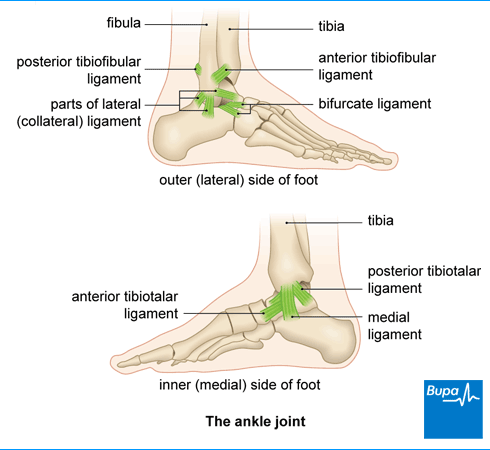 Sprained ankle