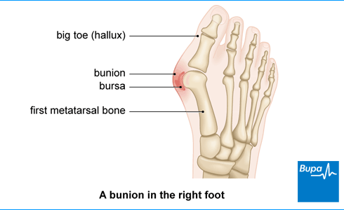 Bunions treatment and causes | Healthcare | Bupa UK