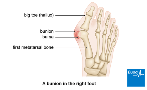 Image showing a bunion in the right foot