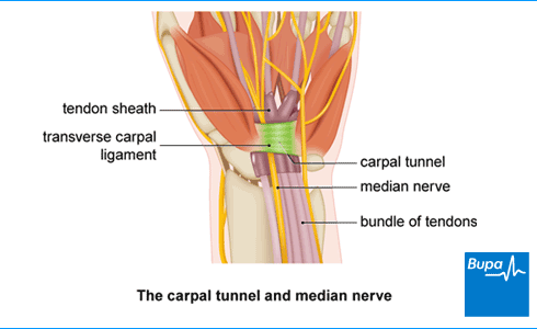 Carpal Tunnel Syndrome: Symptoms and Treatment