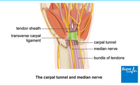 Carpal Tunnel Syndrome Treatment