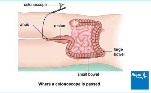 Colonoscopy Prep Diet Alcohol