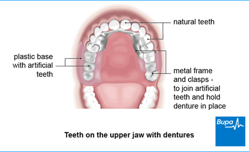 Image showing teeth on the upper jaw with dentures