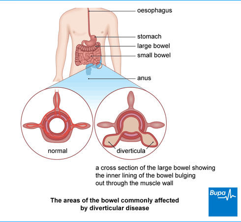 Image showing the areas of the bowel commonly affected by diverticular disease Image showing the areas of the bowel commonly affected by diverticular disease
