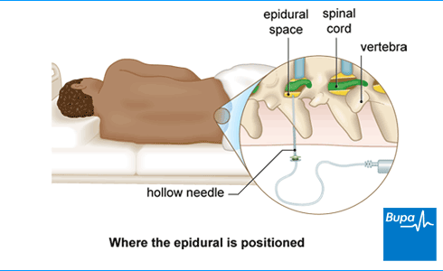 Image showing where the epidural is positioned Image showing where the epidural is positioned