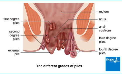 Haemorrhoids (Piles): Symptoms and Causes
