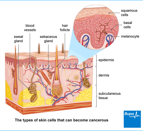 An image showing a diagram of skin cancer