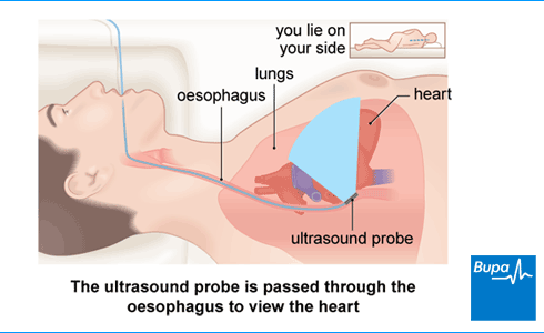 An image showing the ultrasound probe passed through the oesophagus to view the heart