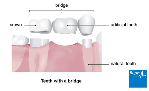 An image showing teeth with a bridge