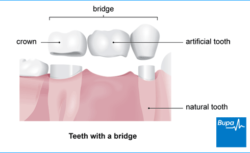 Teeth Repair Kit Temporary Teeth Replacement Kit Moldable False Teeth, Shop Today. Get it Tomorrow!