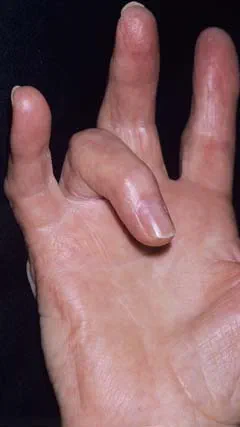 An image showing a hand with trigger finger