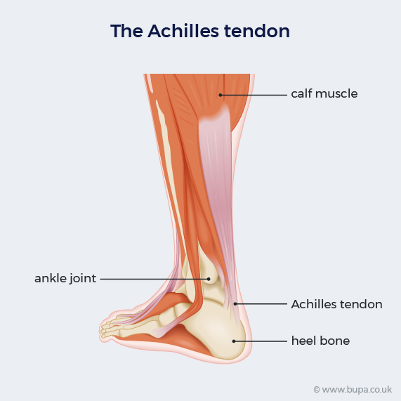 Achilles tendon rupture, Bupa UK