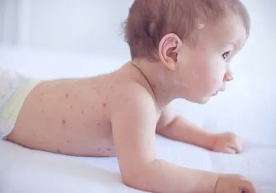 Image showing chickenpox blisters