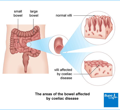 Coeliac disease illustration by Bupa UK