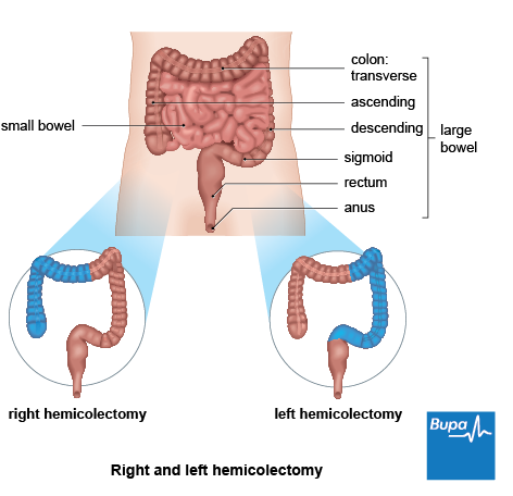 A diagram showing the section of bowel removed during a right and left hemicolectomy