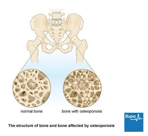 An image showing the structure of bone and bone affected by osteoporosis