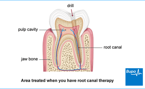 An illustration showing the area treated when you have root canal therapy