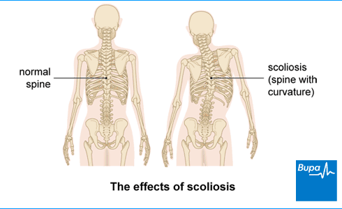 An image showing the effects of scoliosis