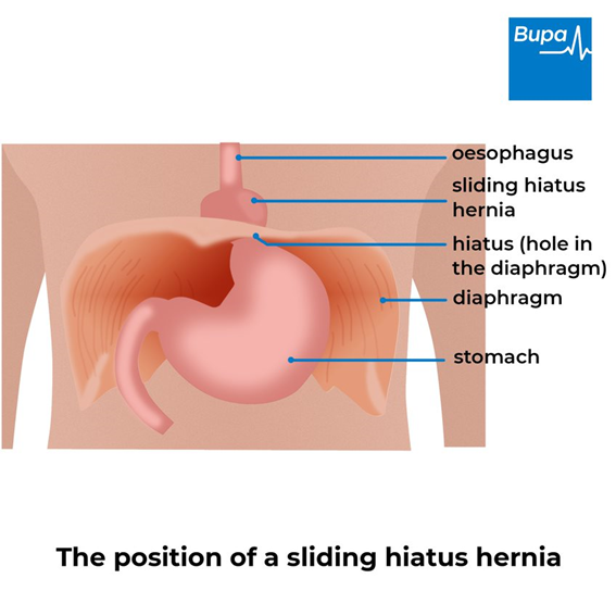Hiatus Hernia Types Causes Symptoms Complications 47 OFF