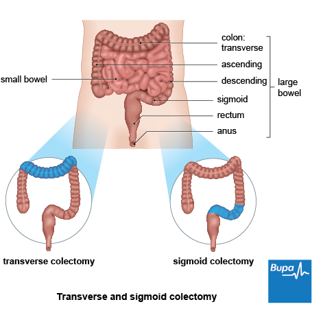 A diagram showing the section of bowel removed during a transverse and sigmoid colectomy