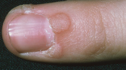 An image showing warts on a person's finger