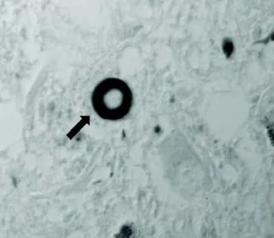 Image of a part of the brain under a microscope, showing a Lewy body