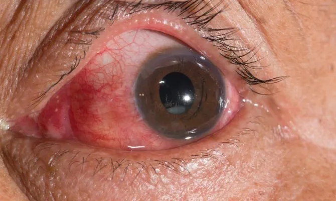a person's eye showing a cataract