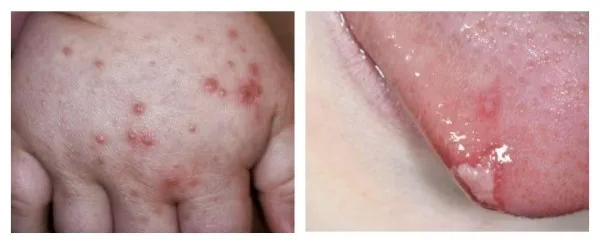 two images - blisters on child's hand and ulcers in the mouth caused by hand, foot and mouth disease