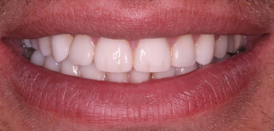 What is Dental Bonding?  Steps, Uses & Benefits Explained