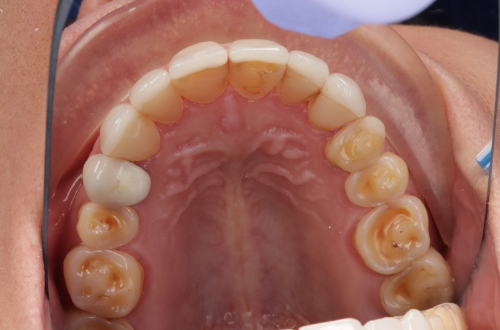 View of the bottom arch of teeth from above, showing how the rear teeth are visibly worn and discoloured