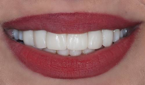 Smiling mouth shows teeth that are white, clean and smooth looking with no visible yellowing or chipped edges