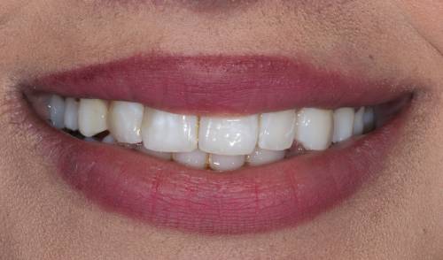 Smiling mouth shows teeth with slight yellowing is seen between the teeth and the left and right cuspid teeth appear chipped with an uneven edge