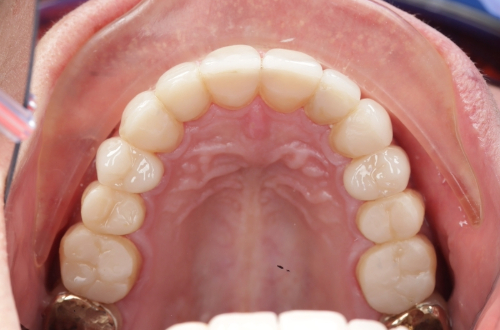 Bottom arch of teeth seen from above, with solid white teeth and rear gold crowns visible