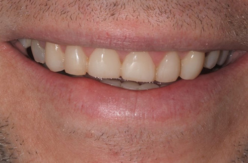 After images shows a fuller smile following composite bonding at Bupa Dental Care Colchester Ipswich Road